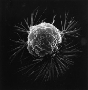 586px-Breast_cancer_cell_2